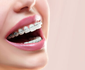 Invisalign
