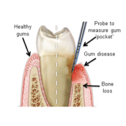 Gum Treatment