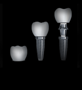 Dental Implants slough