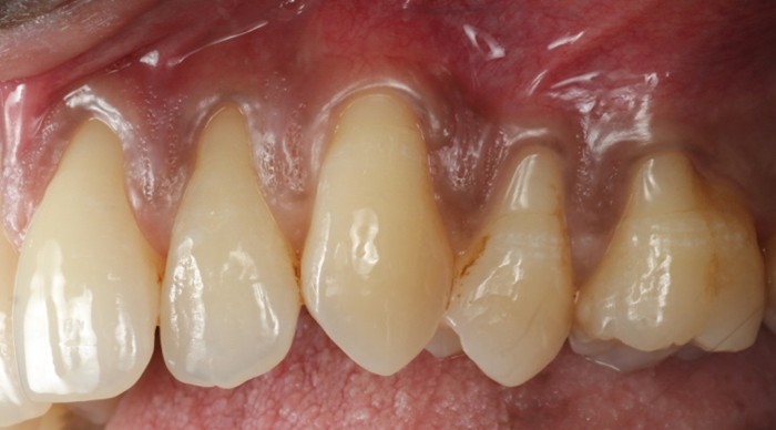Gum disease example