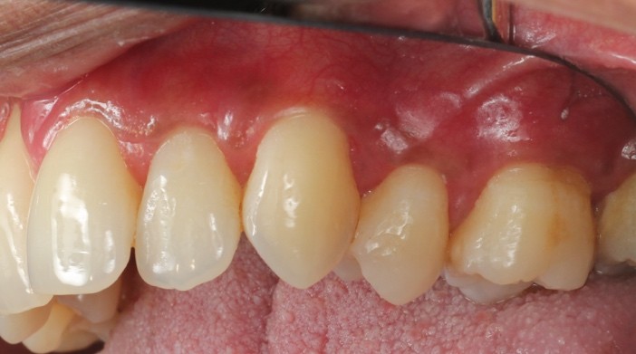 Gum disease example